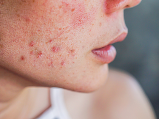 A womans cheek zoomed in showing a skin condition