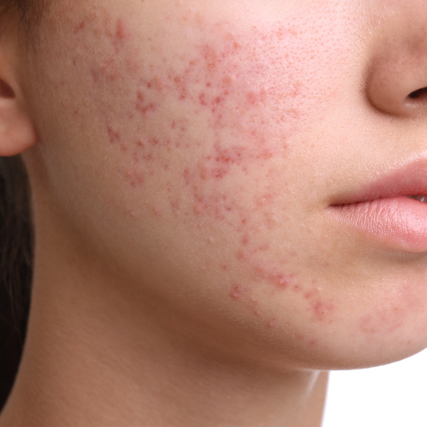 Close up of a woman's face with visible acne, showing inflamed pimples and red blemishes on her cheeks. Before acne treatment Nottingham. 