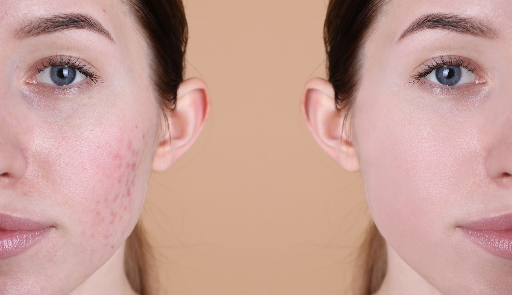 Left side front view showing a lady with eczema on her cheek right side showing clear image of front facing same woman with clear skin after treatment