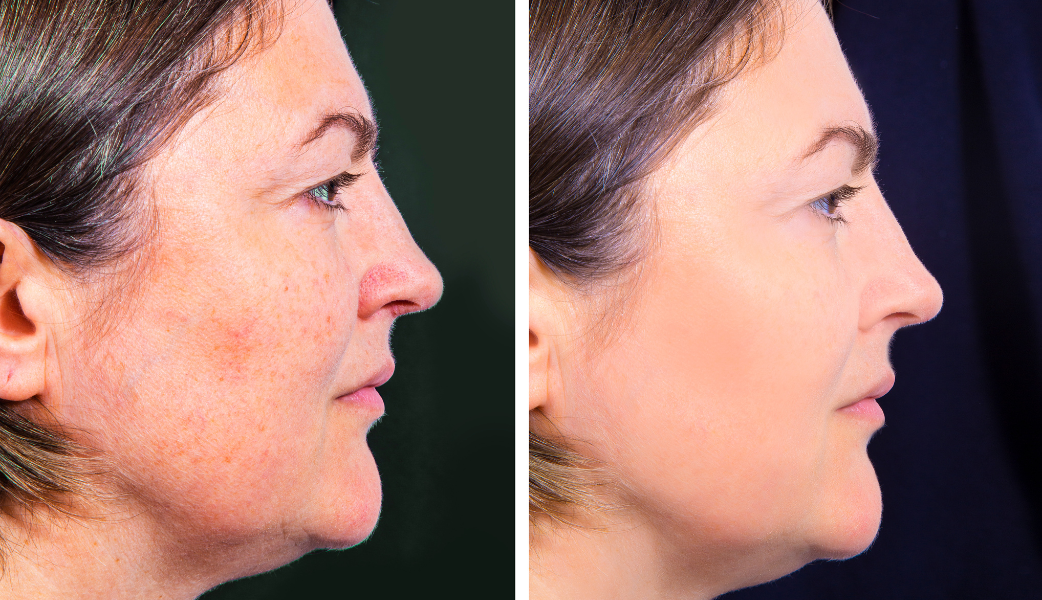 Left side a lady with eczema on her cheek and neck area right size same lady with clearer skin after treatment