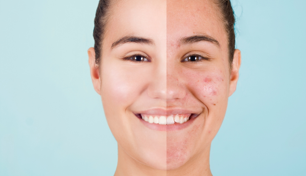 Front facing view of a lady on her left side with clear face after treatment and right side with eczema on her face 