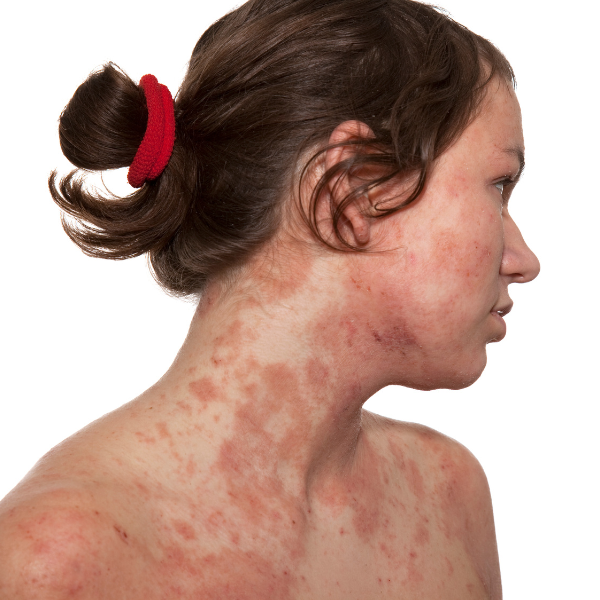 Close up of a woman's face showing red, inflamed patches of eczema on her cheek.