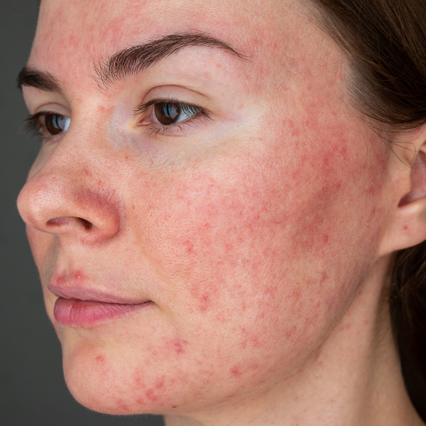 Rosacea Skin Condition Example