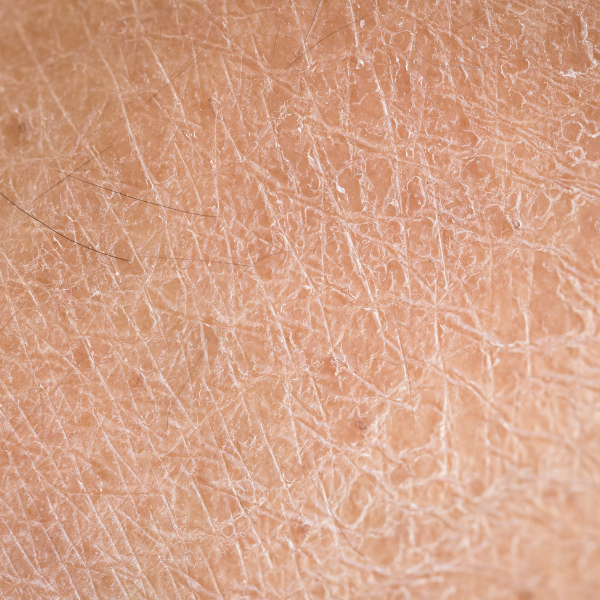 Close up of skin that has laxity on it