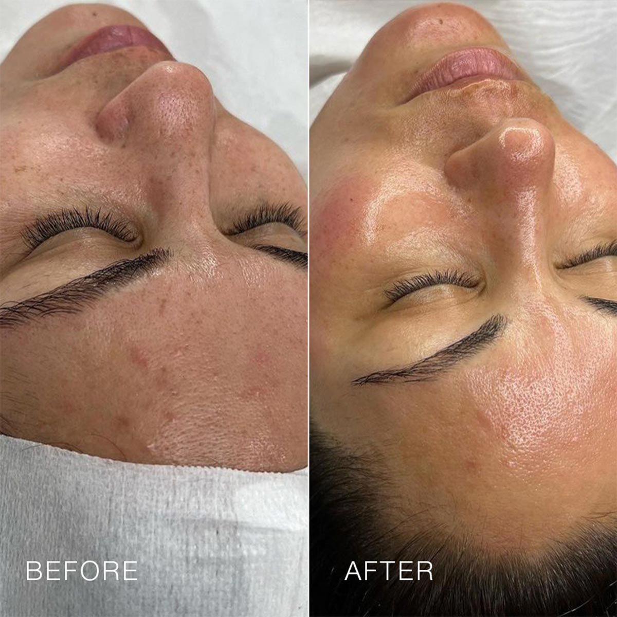 Before and after comparison of a facial treatment, showing improved skin texture and clarity on the "after" side.